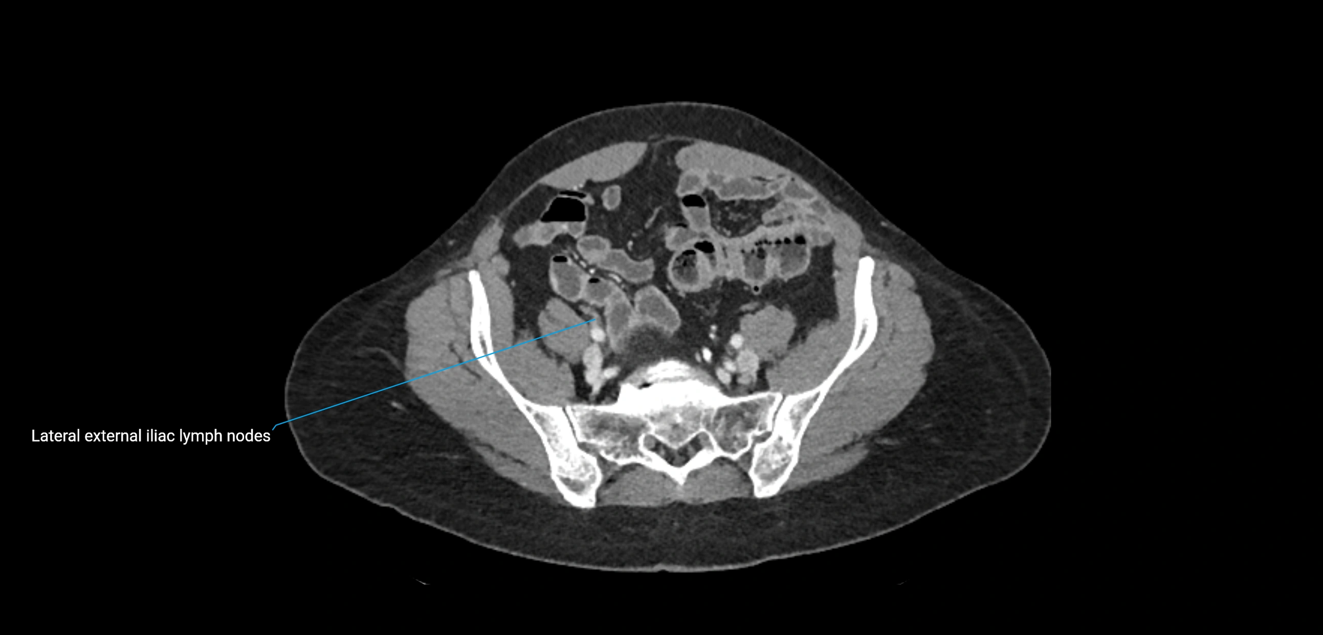 CT ct abdominal lymph nodes  axial cross sectional anatomy  enchanced radiology image -img-00002-00324.webp